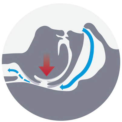 1-1-2_what_causes_snoring_partially_closed_airway-translate